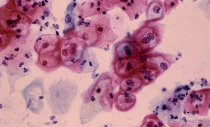 Image: Light micrograph of a cervical smear revealing epithelial cells infected with the human papillomavirus (HPV) (Photo courtesy of SPL).